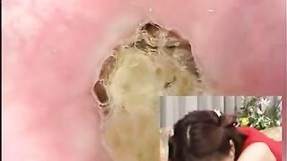 Colonoscopy with Asian girl