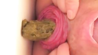 Insane anal prolapse in close up