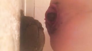 Anal prolapse after pooping a big turd