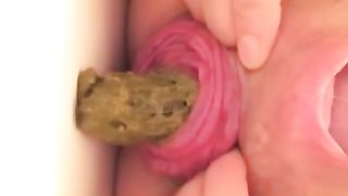 Anal prolapse after pooping