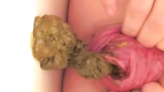 Real anal prolapse