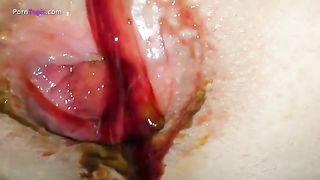 Anal prolapse while pooping