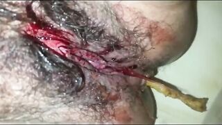 Bloody poop closeup