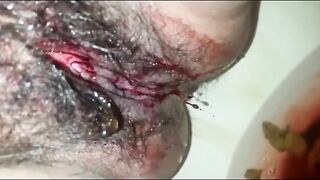Bloody poop closeup
