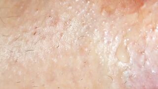 Extreme prolapse huge close up shit