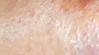 Extreme prolapse huge close up shit