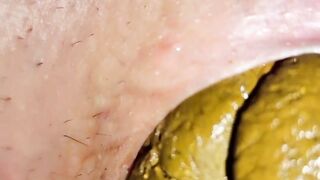 Extreme prolapse huge close up shit